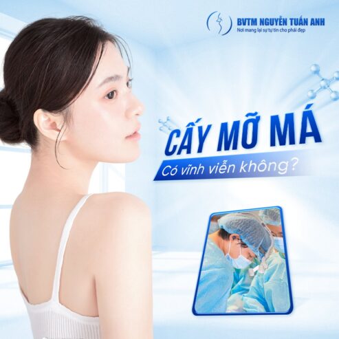 Cấy mỡ má có vĩnh viễn không?