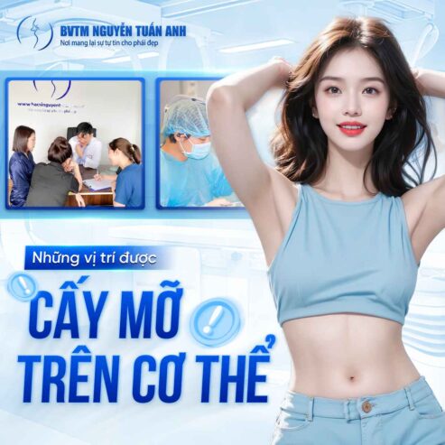 Những vị trí được cấy mỡ trên cơ thể