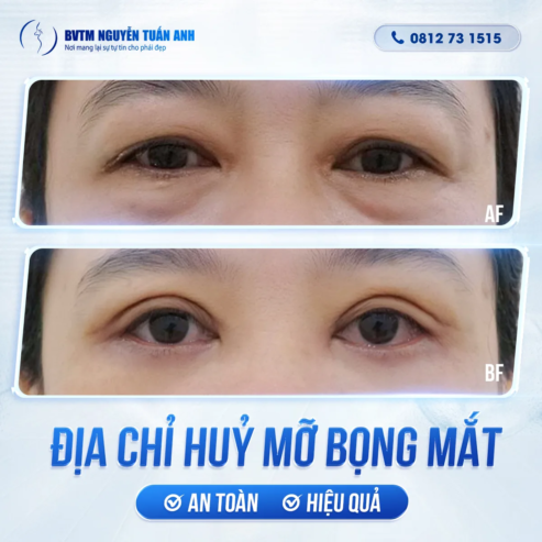 Địa chỉ huỷ mỡ bọng mắt an toàn và hiệu quả