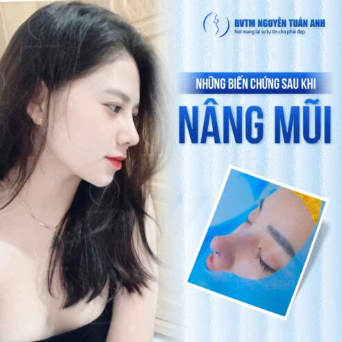 Những biến chứng có thể xảy ra sau khi nâng mũi