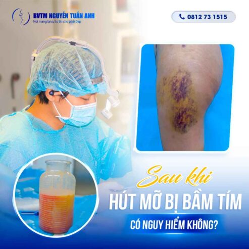 Tại sao sau hút mỡ bị bầm tím?