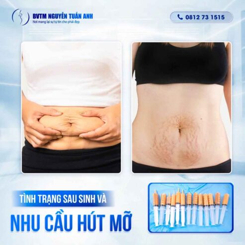 Sau Sinh Có Nên Hút Mỡ Bụng Không?