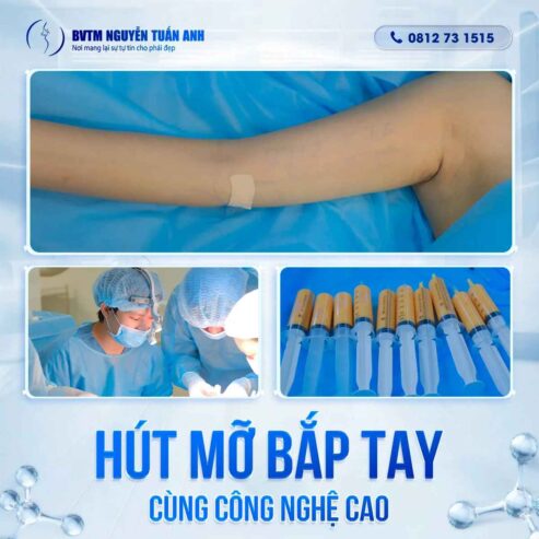 Nguyên nhân tích tụ mỡ vùng bắp tay