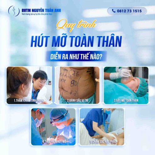 Quy trình hút mỡ toàn thân diễn ra như thế nào?