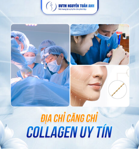 Căng chỉ collagen