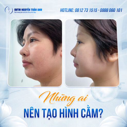 Phẫu thuật tạo hình cằm: Khi nào nên thực hiện để sở hữu gương mặt V-line?