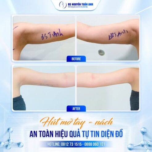 Hút Mỡ Tay Nách – Giải Pháp Cho Vùng Cánh Thon Gọn