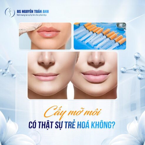 Cấy mỡ môi trên