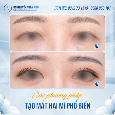 Tạo mắt hai mí đẹp tự nhiên
