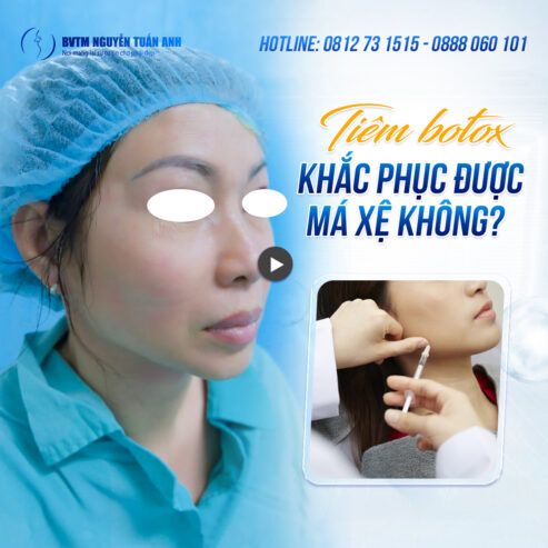Má xệ, da chảy nhão – Botox có phải cứu tinh